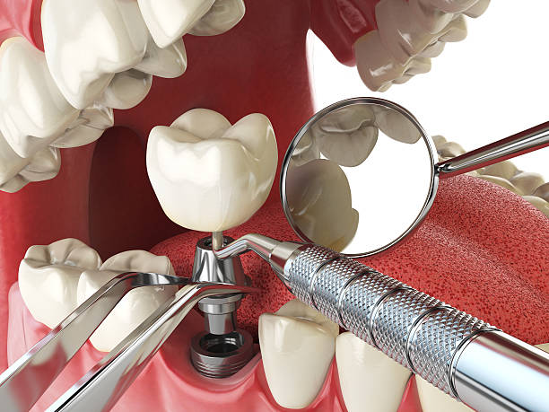 Best Emergency Wisdom Tooth Extraction in Ogallala, NE
